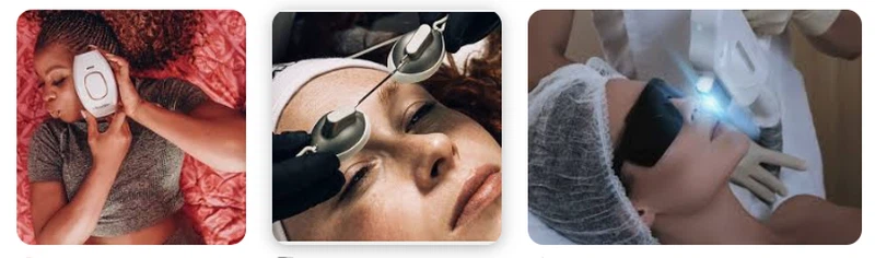 IPL Laser application IPL Laser application